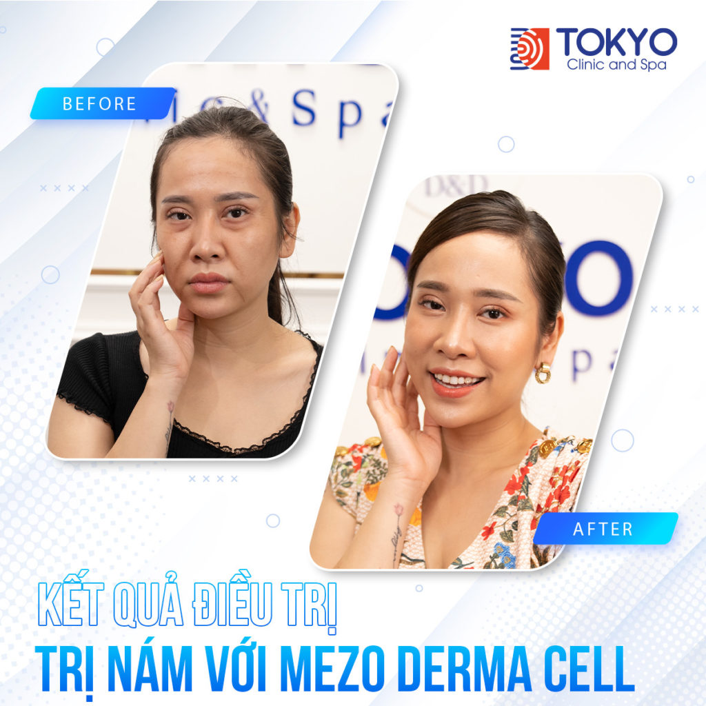 PICOSILVER - Công nghệ xoá sạch mọi khuyết điểm trên da