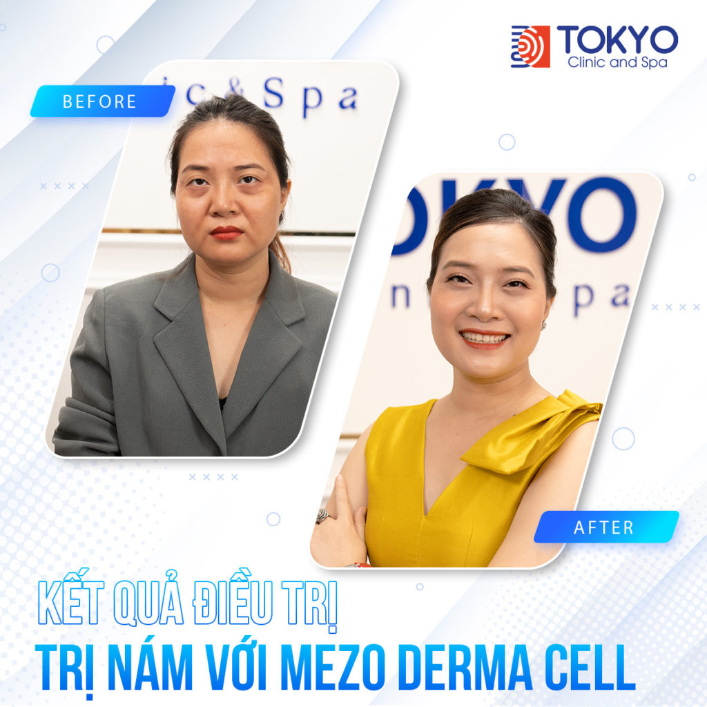 PICOSILVER - Công nghệ xoá sạch mọi khuyết điểm trên da