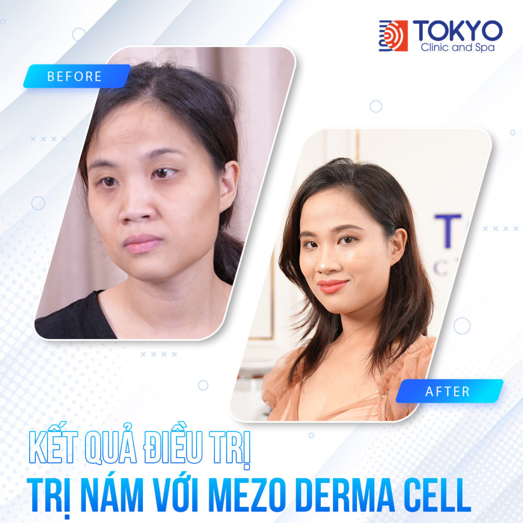 PICOSILVER - Công nghệ xoá sạch mọi khuyết điểm trên da