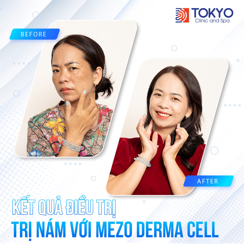 PICOSILVER - Công nghệ xoá sạch mọi khuyết điểm trên da