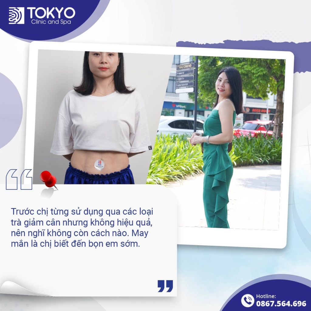 giảm mỡ velashape