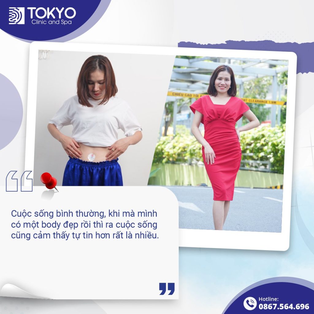 giảm mỡ velashape