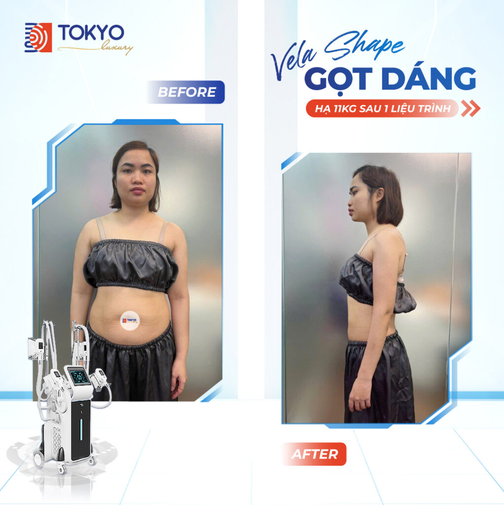  Giảm Béo Toàn Thân Cùng Công Nghệ VelaShape Tại Tokyo Luxury