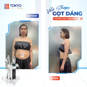 giảm béo công nghệ cao có tốt không