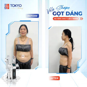 giảm béo công nghệ cao có tốt không