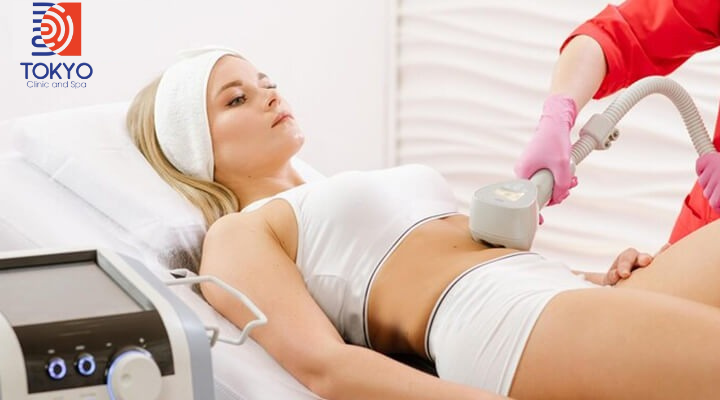 Hút Mỡ Bụng Không Phẫu Thuật