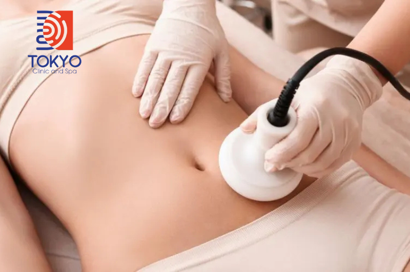 Công nghệ kết hợp sóng siêu âm và RF (Radiofrequency)