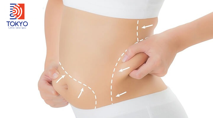Quy Trình Hút Mỡ Bụng Không Phẫu Thuật Diễn Ra Như Thế Nào?