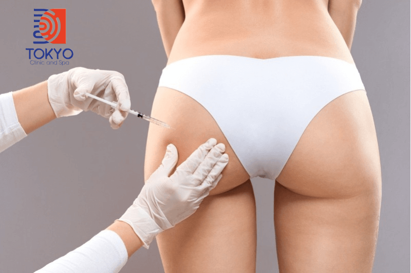 Nâng mông không phẫu thuật giá bao nhiêu?
