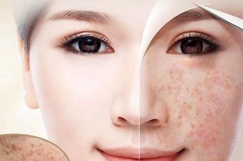 Hiệu quả của bắn tàn nhang bằng laser
