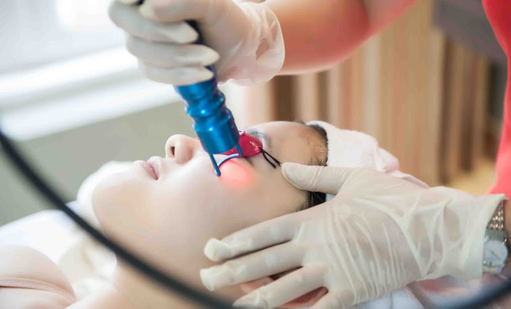 Các loại laser phổ biến trong điều trị tàn nhang