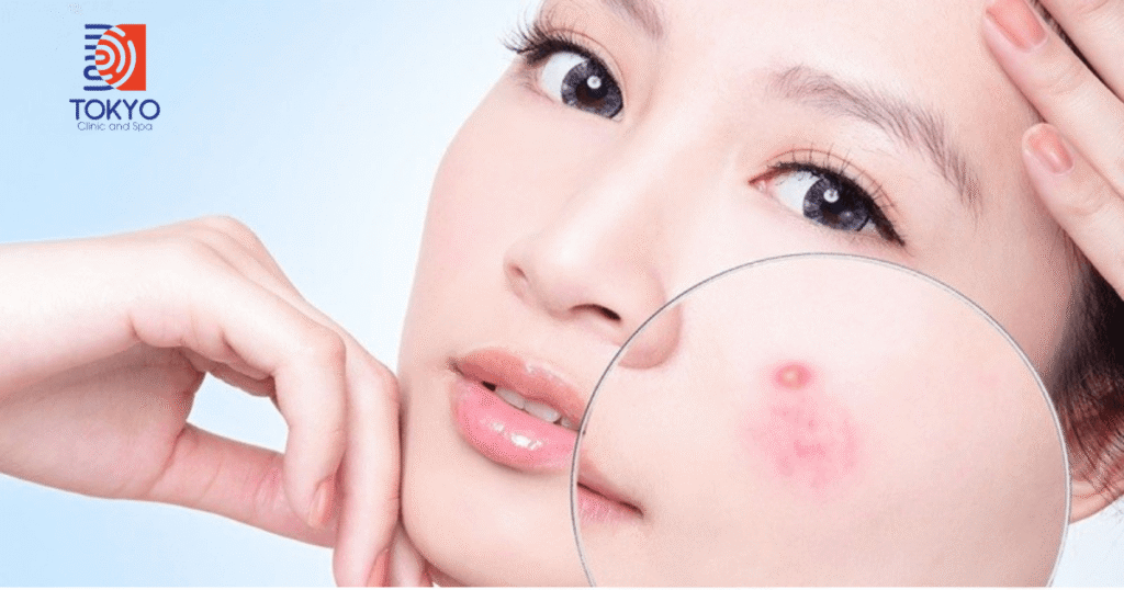 Quy Trình Điều Trị Mụn Chuyên Sâu Chuẩn Y Khoa