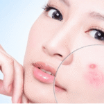 Quy Trình Điều Trị Mụn Chuyên Sâu Chuẩn Y Khoa