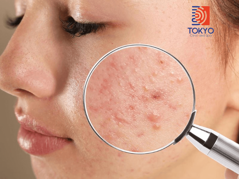 Điều Trị Mụn Chuyên Sâu