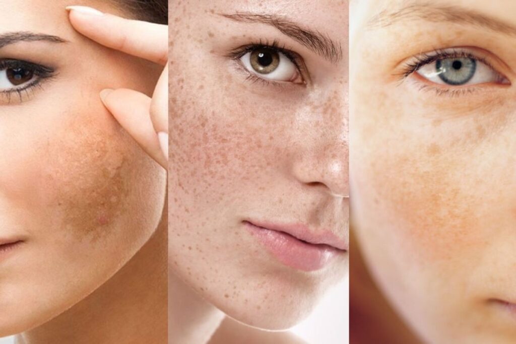 Trị nám bằng laser bao nhiêu tiền