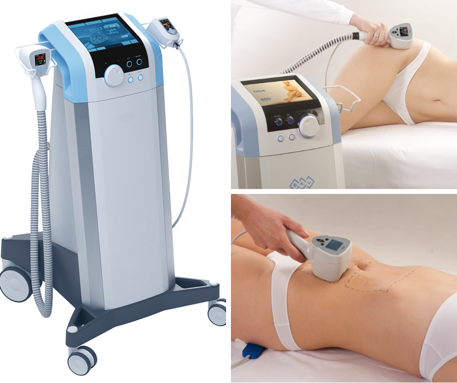 Công nghệ giảm béo Exilis giá bao nhiêu?