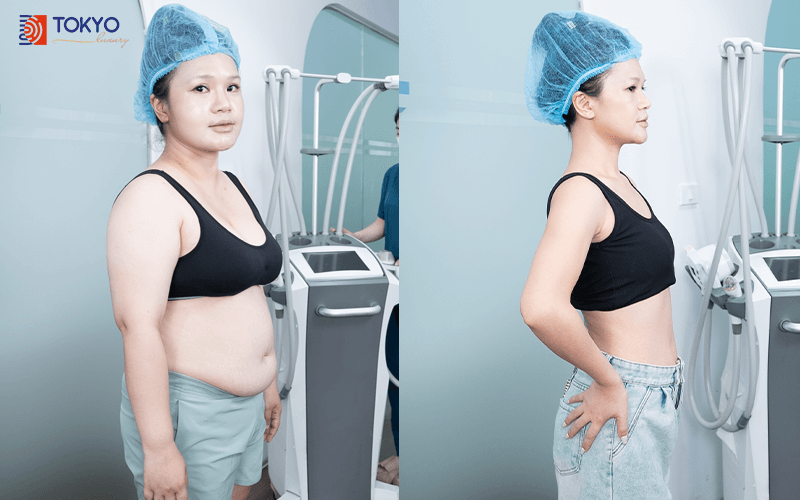 Hành trình tìm lại vòng eo tuổi 50 tại TokyoLuxury