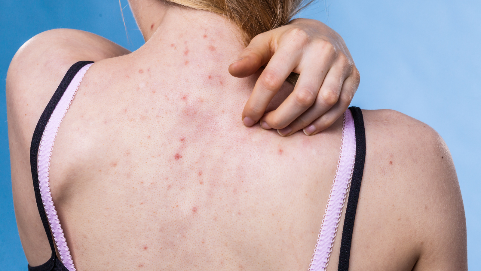 Nguyên nhân bệnh Viêm nang lông